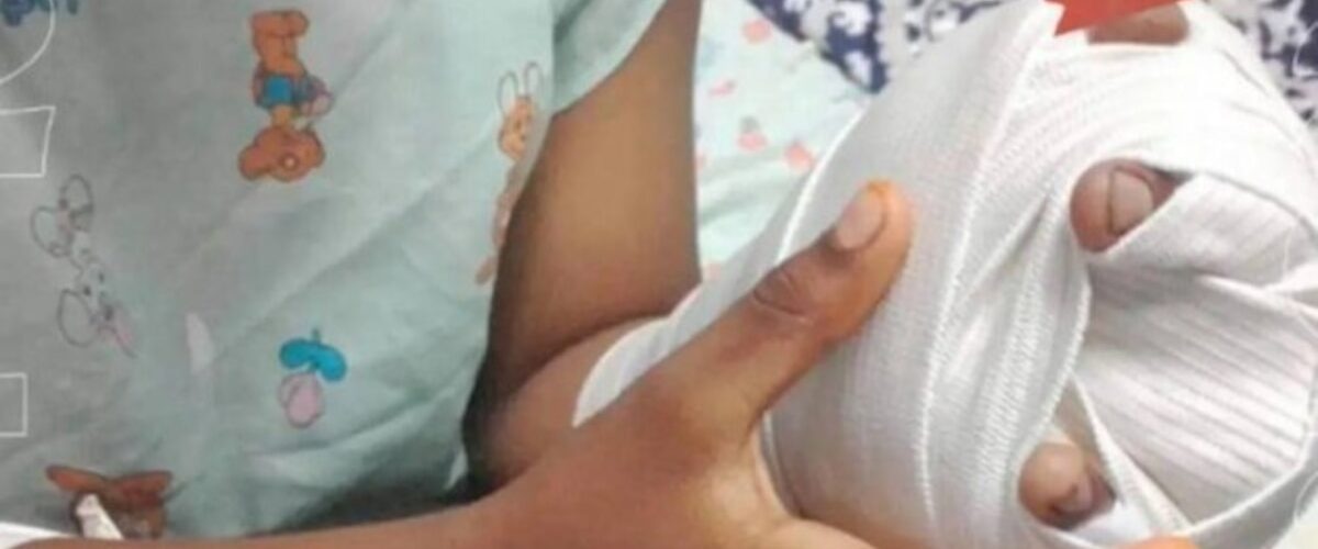 El 53% de las lesiones por quemaduras en El Salvador son de primer grado, con riesgos considerables para los menores.