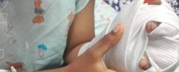 El 53% de las lesiones por quemaduras en El Salvador son de primer grado, con riesgos considerables para los menores.