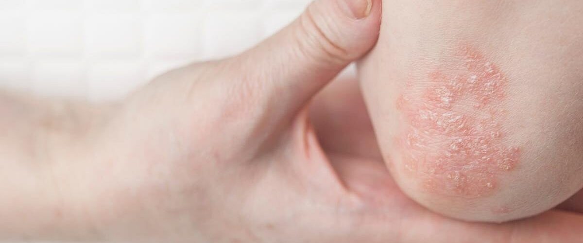 Las enfermedades como lupus y psoriasis aumentan el riesgo de cáncer, revelando un desafío oculto en la cultura pop.