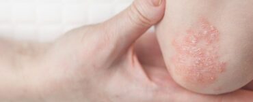 Las enfermedades como lupus y psoriasis aumentan el riesgo de cáncer, revelando un desafío oculto en la cultura pop.